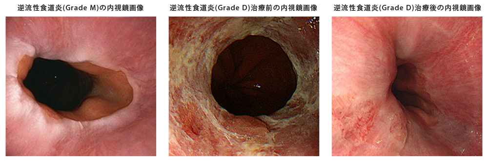 逆流性食道炎の内視鏡画像