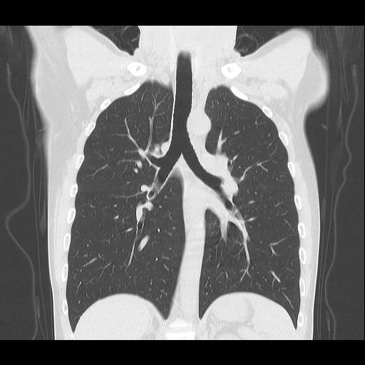 胸部CT検査2